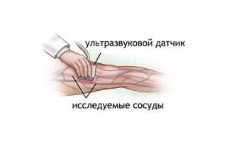 Допплерография сосудов головы, шеи, нижних конечностей — что показывает