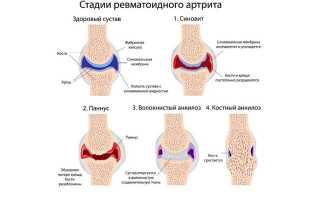 Ревматоидный артрит ‒ симптомы у мужчин и женщин, первые проявления и признаки