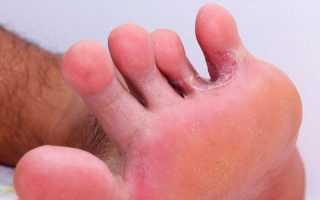 Мазь от грибка между пальцами на ногах