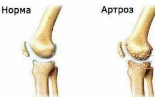 Что за болезнь артроз