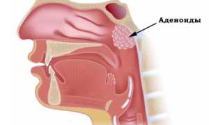 Аденоиды у детей