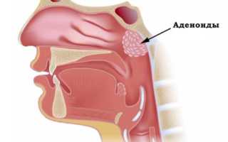Аденоиды у детей