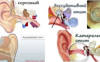 Симптомы отита среднего уха у детей и взрослых