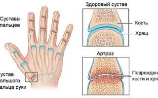 Как лечить артроз пальцев рук