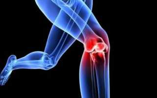 Физкультура при артрозе коленного сустава
