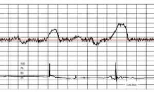 КТГ при беременности