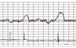 КТГ при беременности