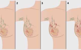 Выживаемость при раке молочной железы