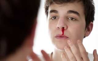 Причины кровотечения из носа у мужчин — травмы, заболевания и внешнее воздействие