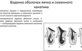 Водянка яичка у ребенка — причины, симптомы, лечение и последствия