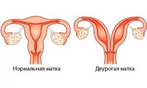 Двурогая матка и беременность