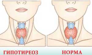 Гипотиреоз у детей