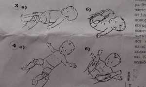Упражнения при дисплазии тазобедренных суставов у детей