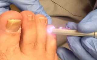 Лечение грибка ногтей медикаментозными и народными средствами в домашних условиях