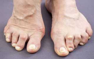 Мазь от артрита пальцев ног