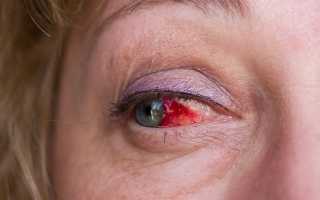 Инсульт глаза — причины и признаки заболевания, диагностика, методы лечения, возможные осложнения