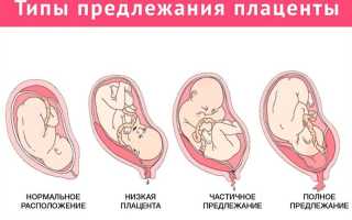 Предлежание плаценты