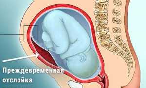 Преждевременная отслойка нормально расположенной плаценты