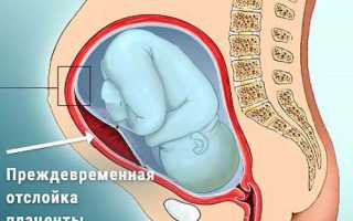 Преждевременная отслойка нормально расположенной плаценты