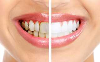 Что такое виниры для зубов: плюсы и минусы