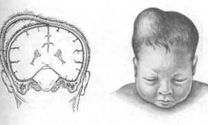 Кефалогематома у новорожденного