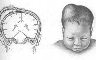 Кефалогематома у новорожденного