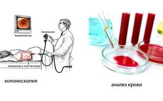 Лигирование геморроидальных узлов латексными кольцами