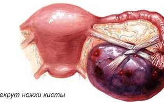 Симптомы и лечение эндометриоидной кисты яичника